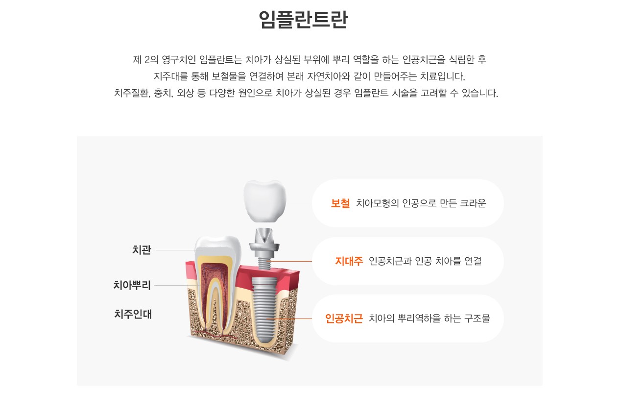 임플란트란? 제 2의 영구치인 임플란트는 치아가 상실된 부위에 뿌리 역할을 하는 인공치근을 식립한 후
지주대를 통해 보철물을 연결하여 본래 자연치아와 같이 만들어주는 치료입니다.
치주질환, 충치, 외상 등 다양한 원인으로 치아가 상실된 경우 임플란트 시술을 고려할 수 있습니다.