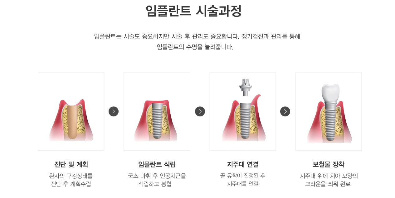 임플란트 시술과정 임플란트는 시술도 중요하지만 시술 후 관리도 중요합니다. 정기검진과 관리를 통해
임플란트의 수명을 늘려줍니다.